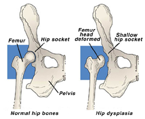 Illustration of normal and hip dysplasia bones